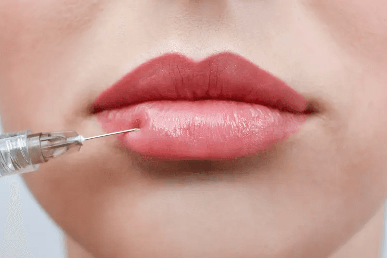 Lip Fillers