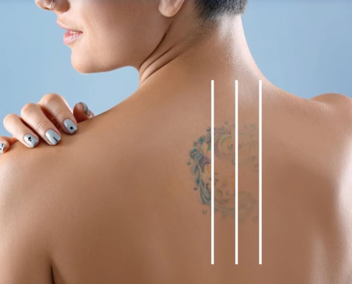 Tattoo Removal